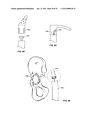 IMPLANT COMPONENTS AND METHODS diagram and image