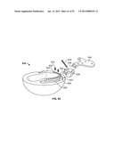 IMPLANT COMPONENTS AND METHODS diagram and image