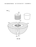 IMPLANT COMPONENTS AND METHODS diagram and image