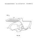 IMPLANT COMPONENTS AND METHODS diagram and image