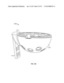 IMPLANT COMPONENTS AND METHODS diagram and image