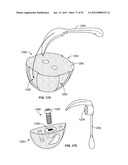 IMPLANT COMPONENTS AND METHODS diagram and image