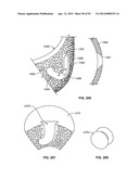 IMPLANT COMPONENTS AND METHODS diagram and image