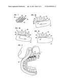 METHOD AND APPARATUS FOR INDIRECT BONDING OF ORTHODONTIC APPLIANCES TO     TEETH diagram and image