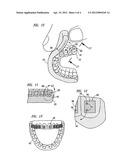 METHOD AND APPARATUS FOR INDIRECT BONDING OF ORTHODONTIC APPLIANCES TO     TEETH diagram and image