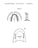 Differential Vibratation Of Dental Plate diagram and image
