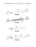 SELF-ADJUSTING GASTRIC BAND diagram and image