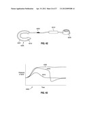 SELF-ADJUSTING GASTRIC BAND diagram and image