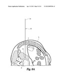 Expandable Spinal Access Instruments and Methods of Use diagram and image