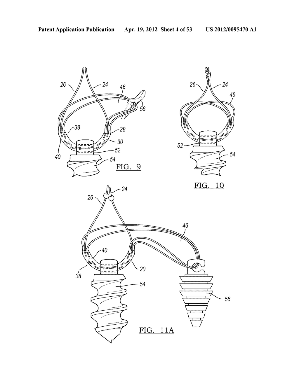 Method and Apparatus for Coupling Soft Tissue to a Bone - diagram, schematic, and image 05