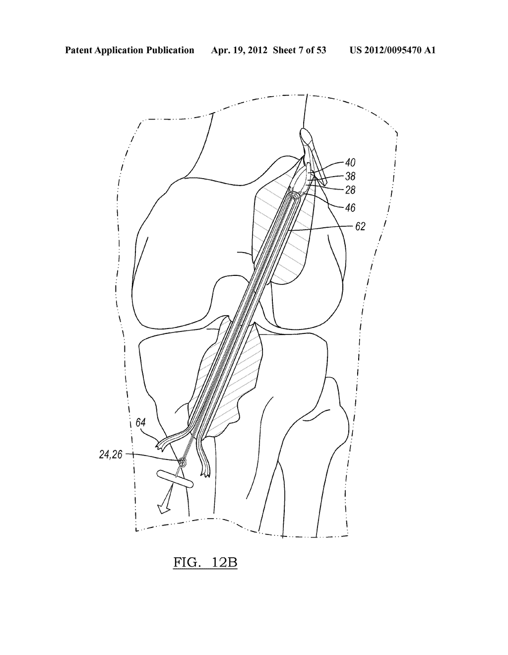 Method and Apparatus for Coupling Soft Tissue to a Bone - diagram, schematic, and image 08