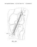 Method and Apparatus for Coupling Soft Tissue to a Bone diagram and image