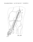 Method and Apparatus for Coupling Soft Tissue to a Bone diagram and image