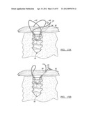 Method and Apparatus for Coupling Soft Tissue to a Bone diagram and image