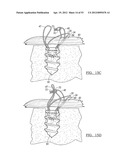 Method and Apparatus for Coupling Soft Tissue to a Bone diagram and image