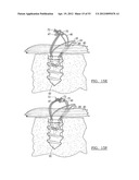 Method and Apparatus for Coupling Soft Tissue to a Bone diagram and image