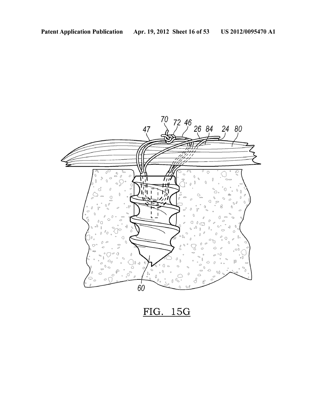 Method and Apparatus for Coupling Soft Tissue to a Bone - diagram, schematic, and image 17