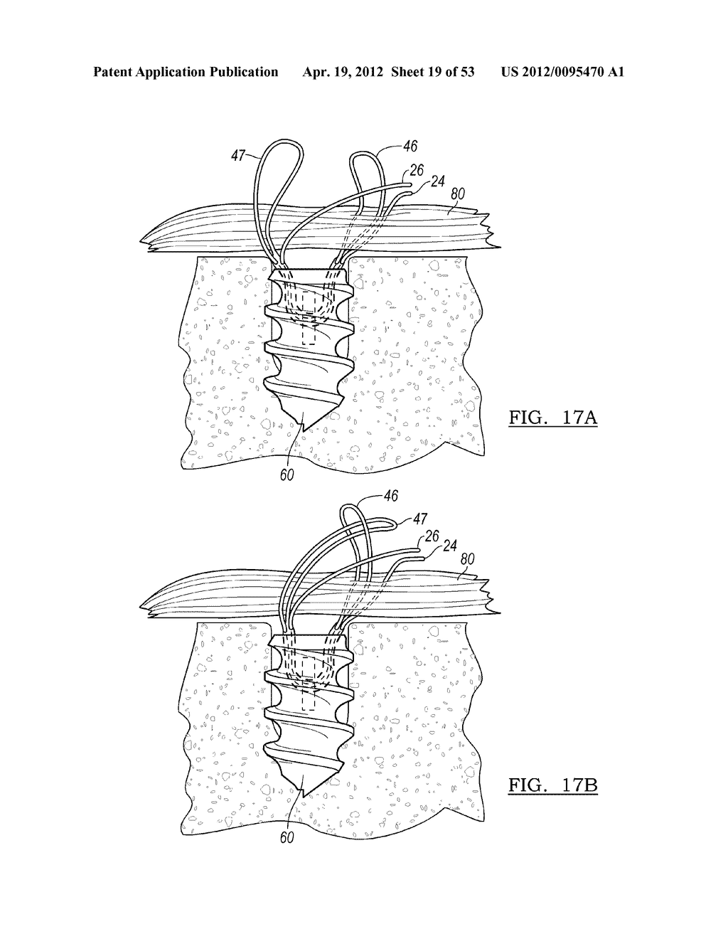 Method and Apparatus for Coupling Soft Tissue to a Bone - diagram, schematic, and image 20
