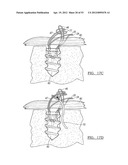 Method and Apparatus for Coupling Soft Tissue to a Bone diagram and image