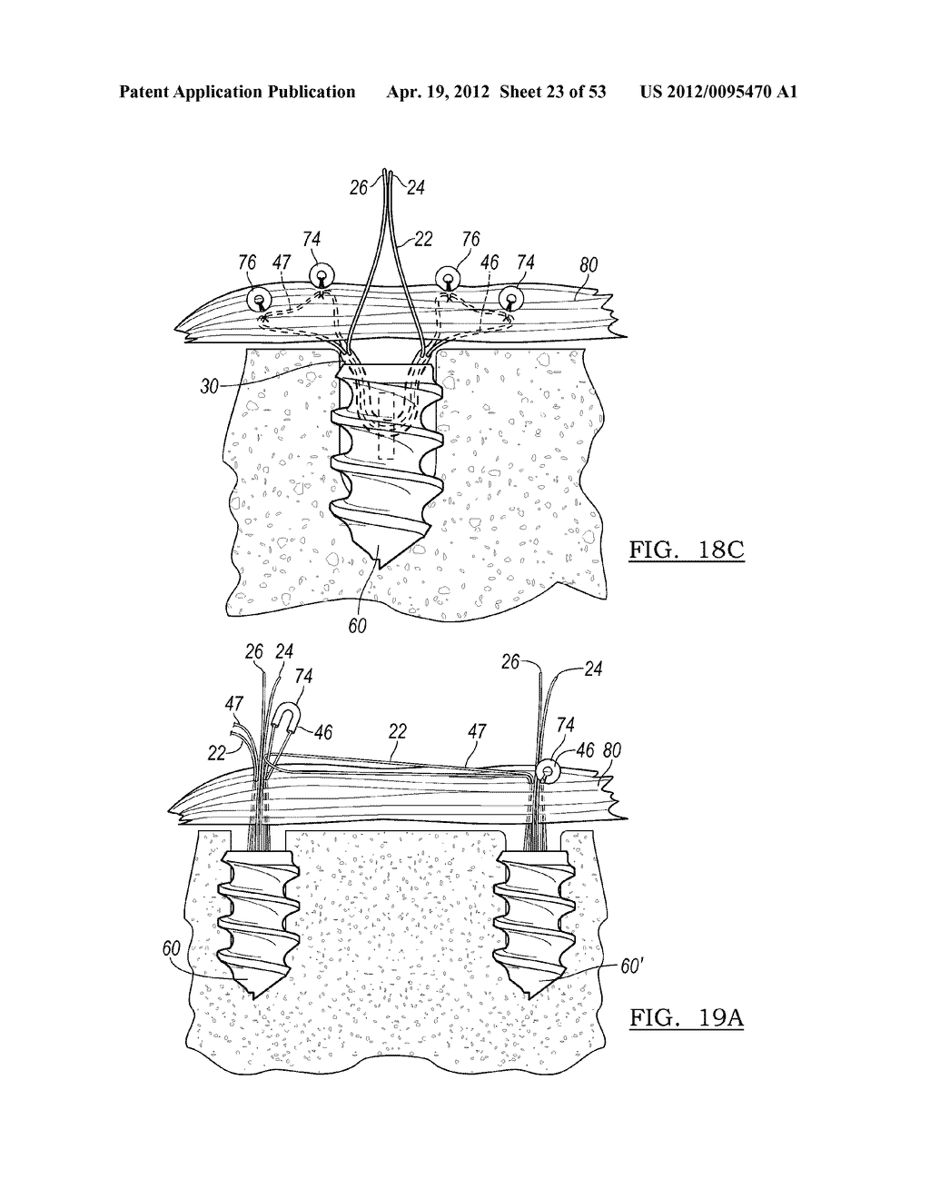 Method and Apparatus for Coupling Soft Tissue to a Bone - diagram, schematic, and image 24