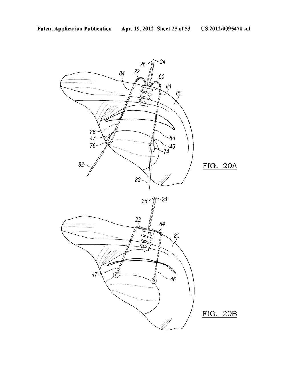 Method and Apparatus for Coupling Soft Tissue to a Bone - diagram, schematic, and image 26