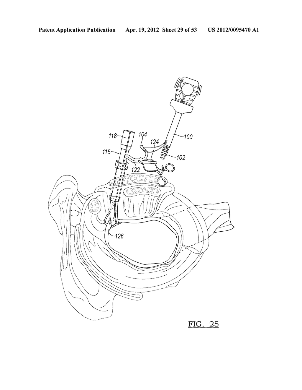 Method and Apparatus for Coupling Soft Tissue to a Bone - diagram, schematic, and image 30
