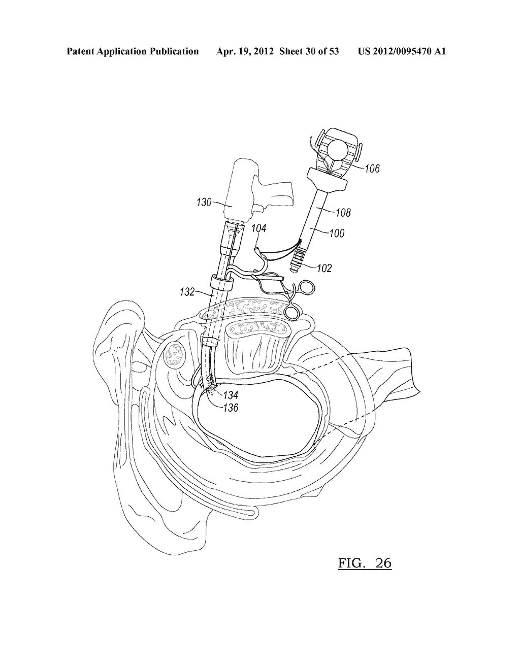Method and Apparatus for Coupling Soft Tissue to a Bone - diagram, schematic, and image 31