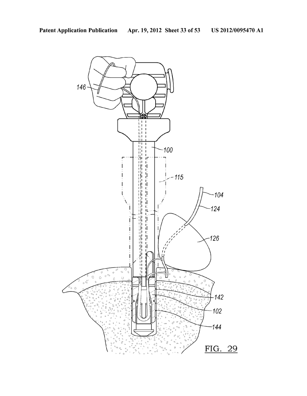 Method and Apparatus for Coupling Soft Tissue to a Bone - diagram, schematic, and image 34