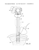 Method and Apparatus for Coupling Soft Tissue to a Bone diagram and image