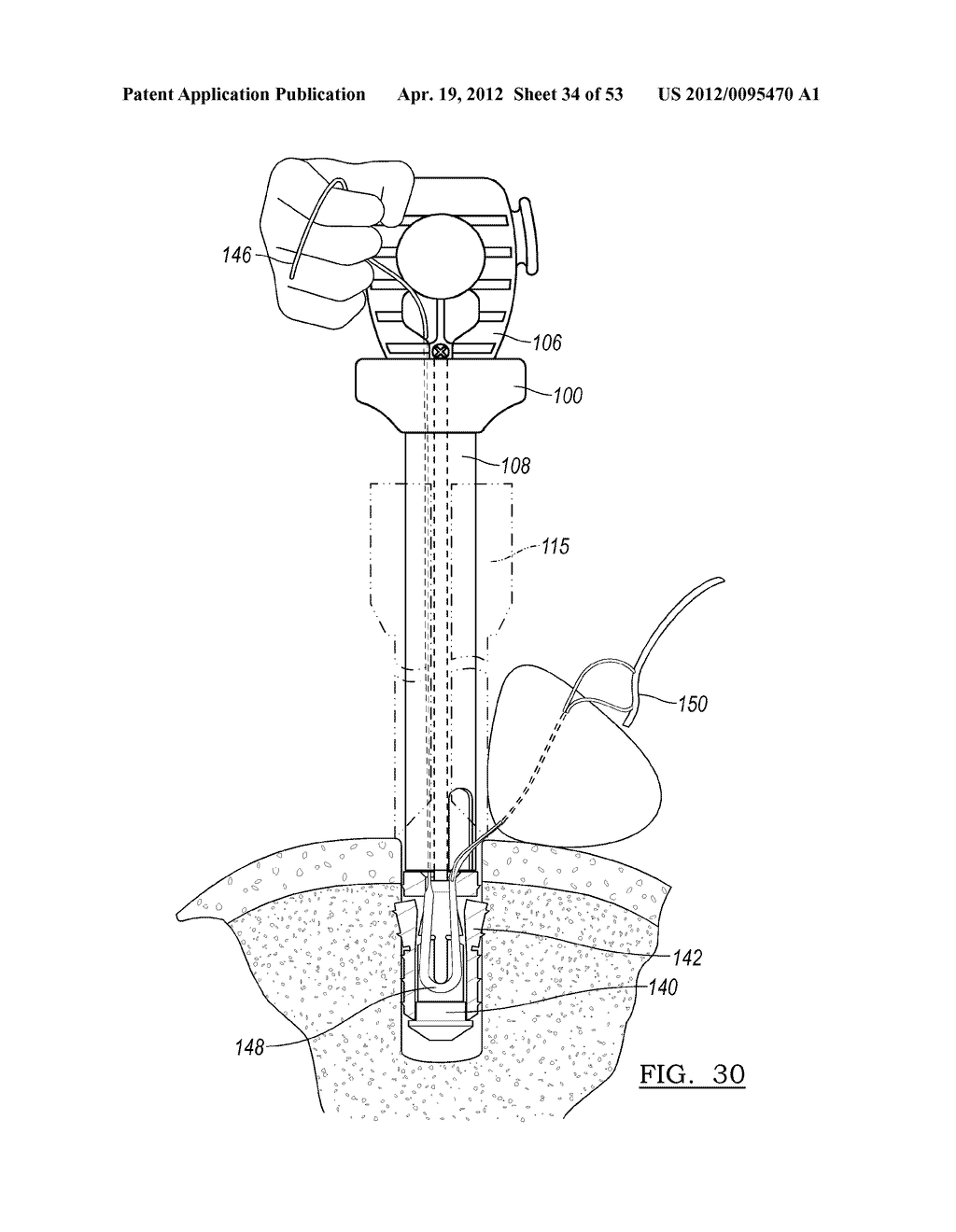 Method and Apparatus for Coupling Soft Tissue to a Bone - diagram, schematic, and image 35