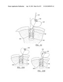 Method and Apparatus for Coupling Soft Tissue to a Bone diagram and image