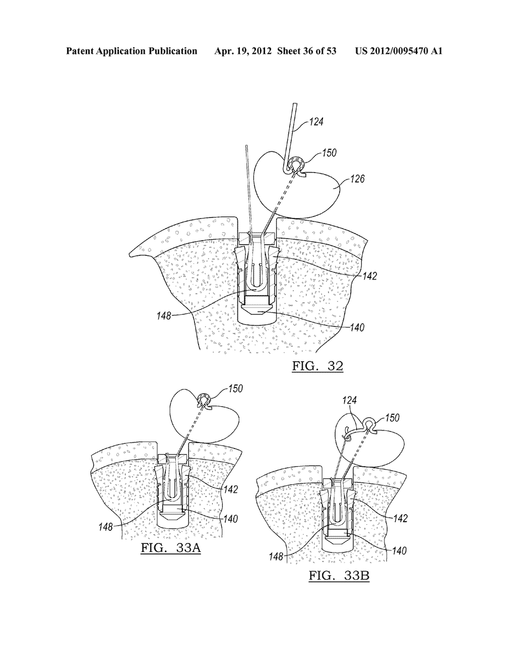 Method and Apparatus for Coupling Soft Tissue to a Bone - diagram, schematic, and image 37