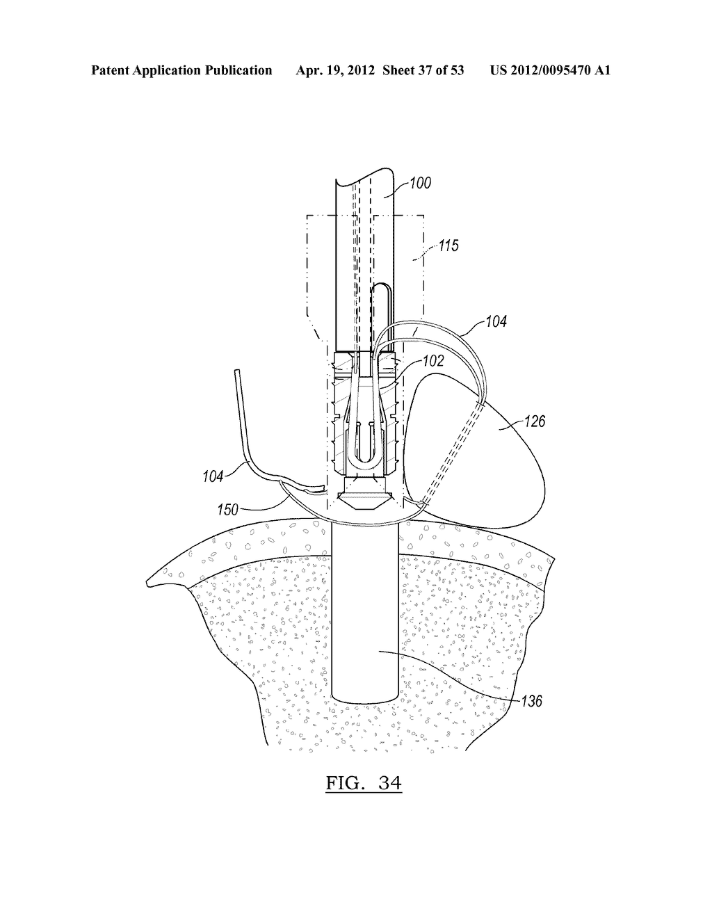 Method and Apparatus for Coupling Soft Tissue to a Bone - diagram, schematic, and image 38