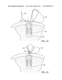 Method and Apparatus for Coupling Soft Tissue to a Bone diagram and image