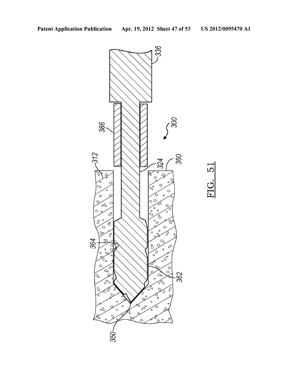 Method and Apparatus for Coupling Soft Tissue to a Bone - diagram, schematic, and image 48