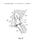 SELF EXPANDABLE MIDDLE EAR IMPLANT FOR TREATING HEARING RELATED DISORDERS diagram and image