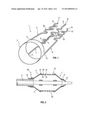 STENT MOVEMENT PREVENTING DEVICE diagram and image