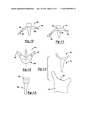 Method And Apparatus For Wrist Arthroplasty diagram and image