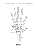 Method And Apparatus For Wrist Arthroplasty diagram and image