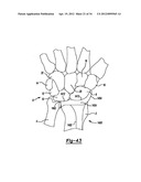 Method And Apparatus For Wrist Arthroplasty diagram and image