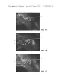 Intralymphatic Chemotherapy Drug Carriers diagram and image