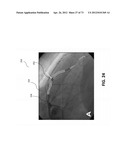 METHODS AND SYSTEMS FOR DETERMINING VASCULAR BODILY LUMEN INFORMATION AND     GUIDING MEDICAL DEVICES diagram and image