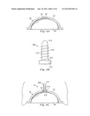 Methods for Detecting Osteolytic Conditions in the Body diagram and image