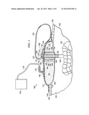 REDUCED-PRESSURE SYSTEMS, DEVICES, AND METHODS FOR TREATING A TISSUE SITE     THAT INCLUDES A FISTULA diagram and image