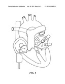 BALLOON CATHETER WITH DEFORMABLE FLUID DELIVERY CONDUIT diagram and image