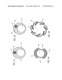 Systems And Methods For Removing Obstructive Matter From Body Lumens And     Treating Vascular Defects diagram and image