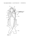 Systems And Methods For Removing Obstructive Matter From Body Lumens And     Treating Vascular Defects diagram and image