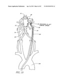 Systems And Methods For Removing Obstructive Matter From Body Lumens And     Treating Vascular Defects diagram and image