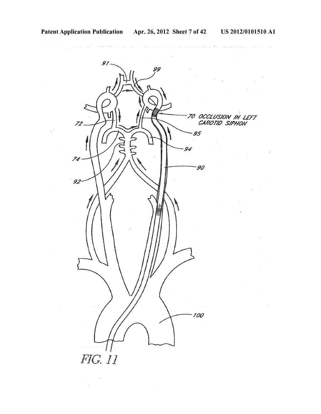 Systems And Methods For Removing Obstructive Matter From Body Lumens And     Treating Vascular Defects - diagram, schematic, and image 08