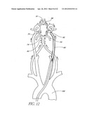 Systems And Methods For Removing Obstructive Matter From Body Lumens And     Treating Vascular Defects diagram and image